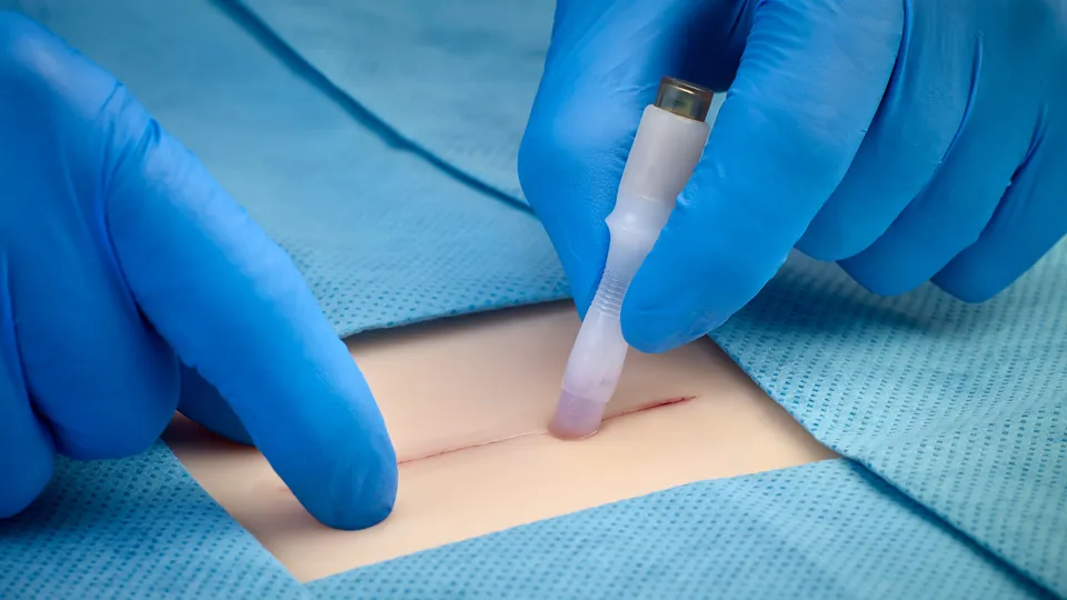 Aplicación precisa — SurgiSeal